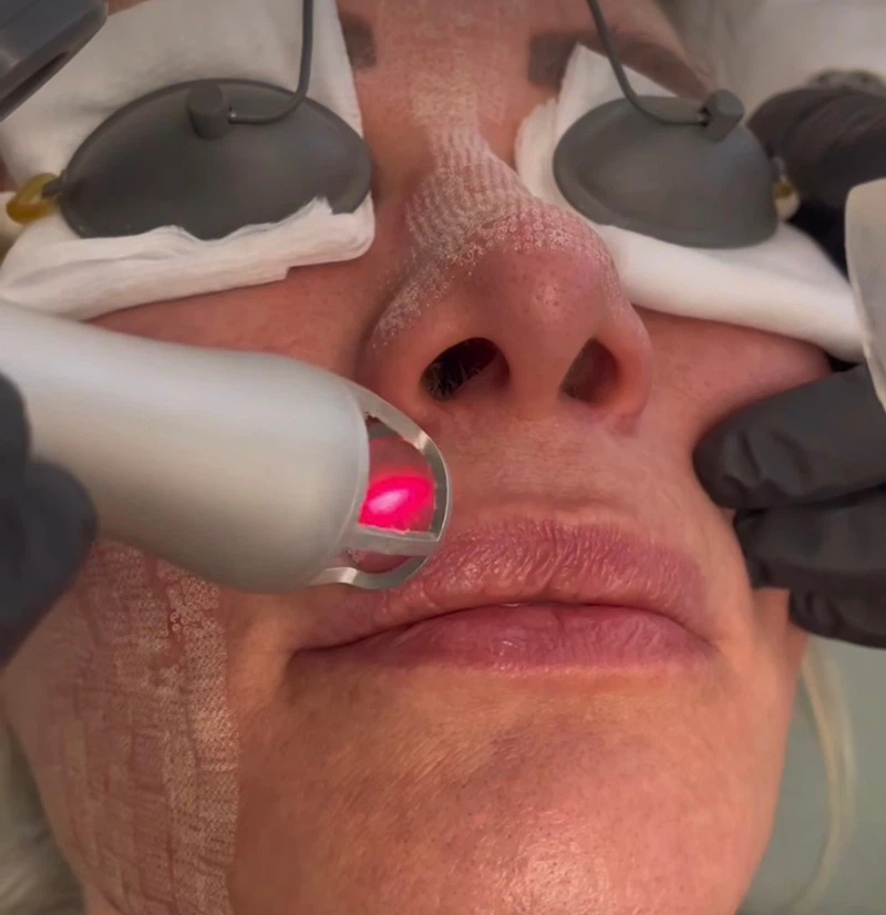 co2 laser treatment co2 laser treatment